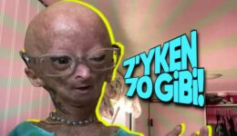Çocukken Yaşlı Görünmeye Sebep Olan Değişik Sendrom: Progeria (Türkiye’de de Örnekleri Var!)