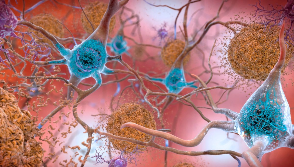 Alzheimer tedavisinde yeni umut: 2 kanser ilacı çare olabilir