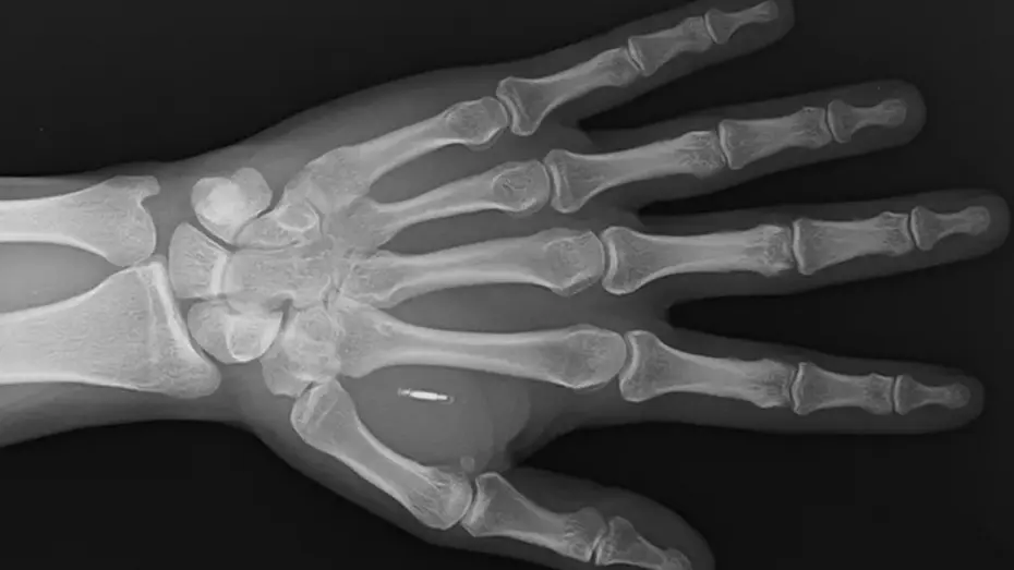 Vücuduna yerleştirdiği çipin şifresini unuttu